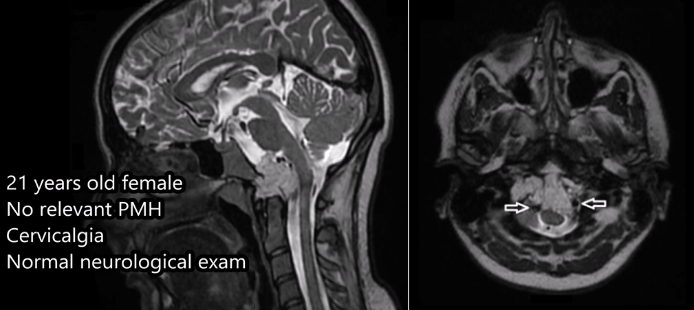 雙鏡聯(lián)合全切顱頸交界區(qū)脊索瘤——術(shù)前MRI